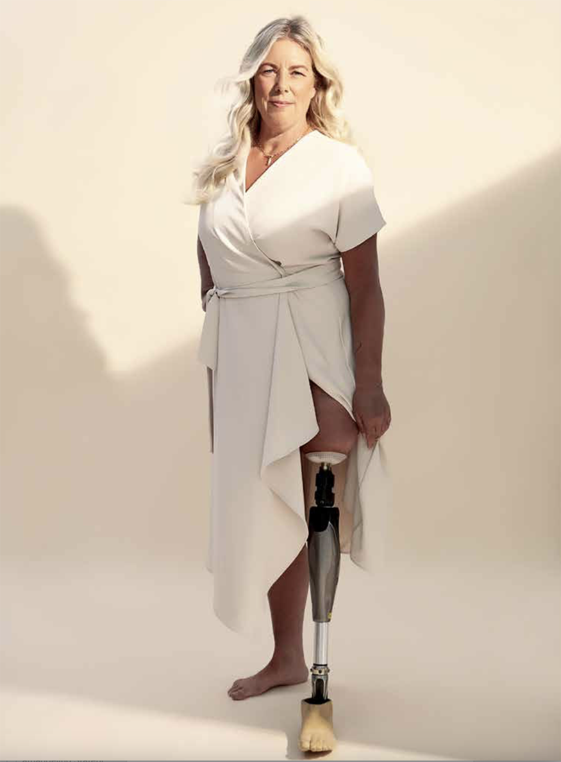 Pietsje (53) verstopte lange tijd haar prothesebeen. “Maar nu draag ik weer rokjes en korte broeken.”